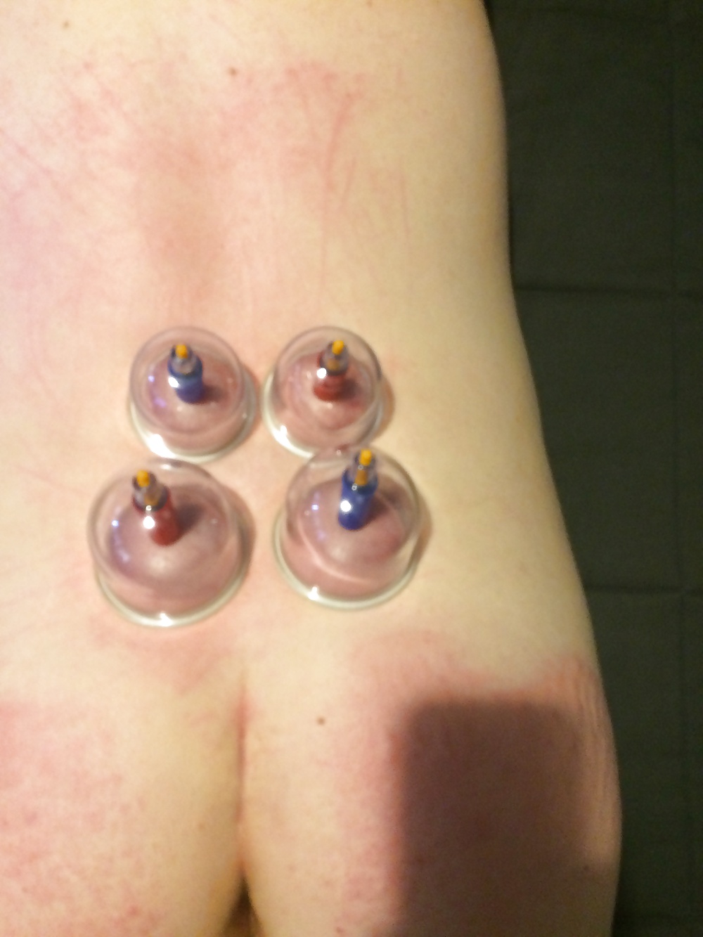 Japanese suction cups massage therapy  #31777189