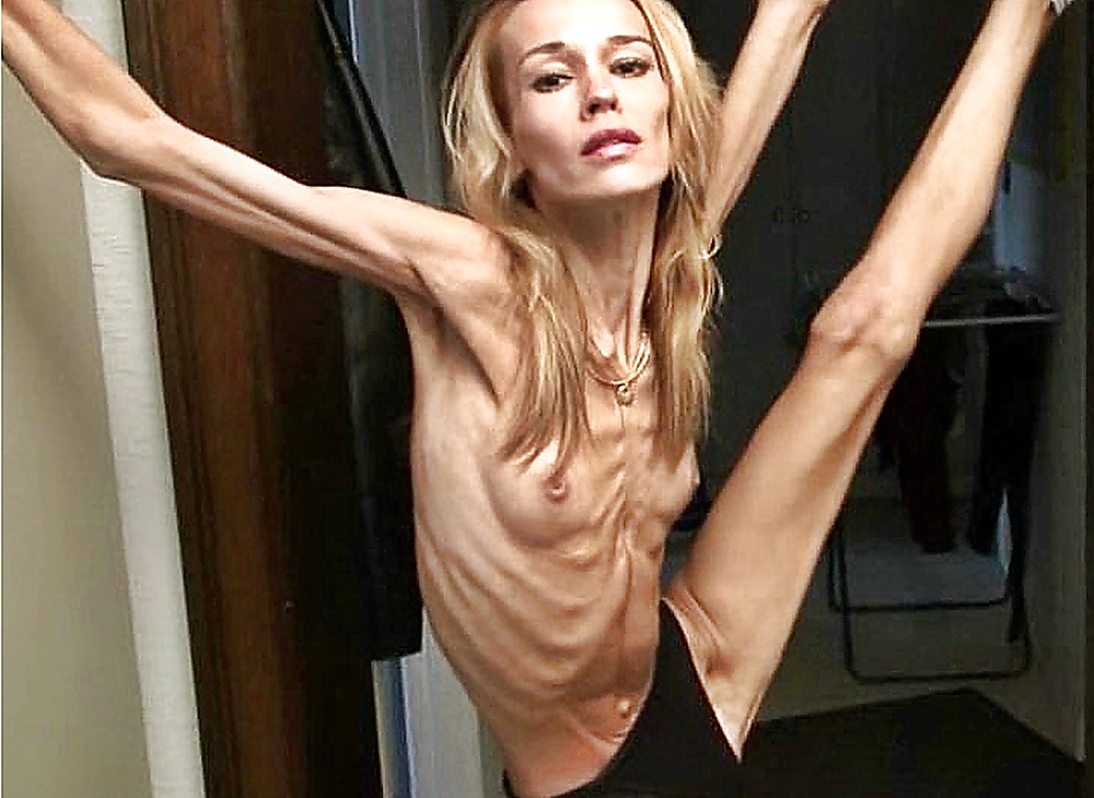 Anoréxica
 #35322970