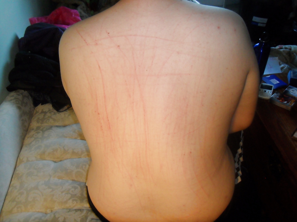 Dermatographia #37601233