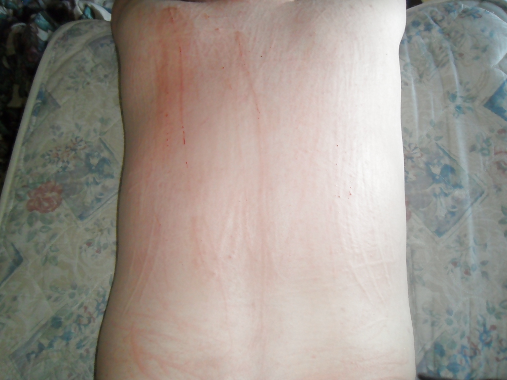 Dermatographia #37601239