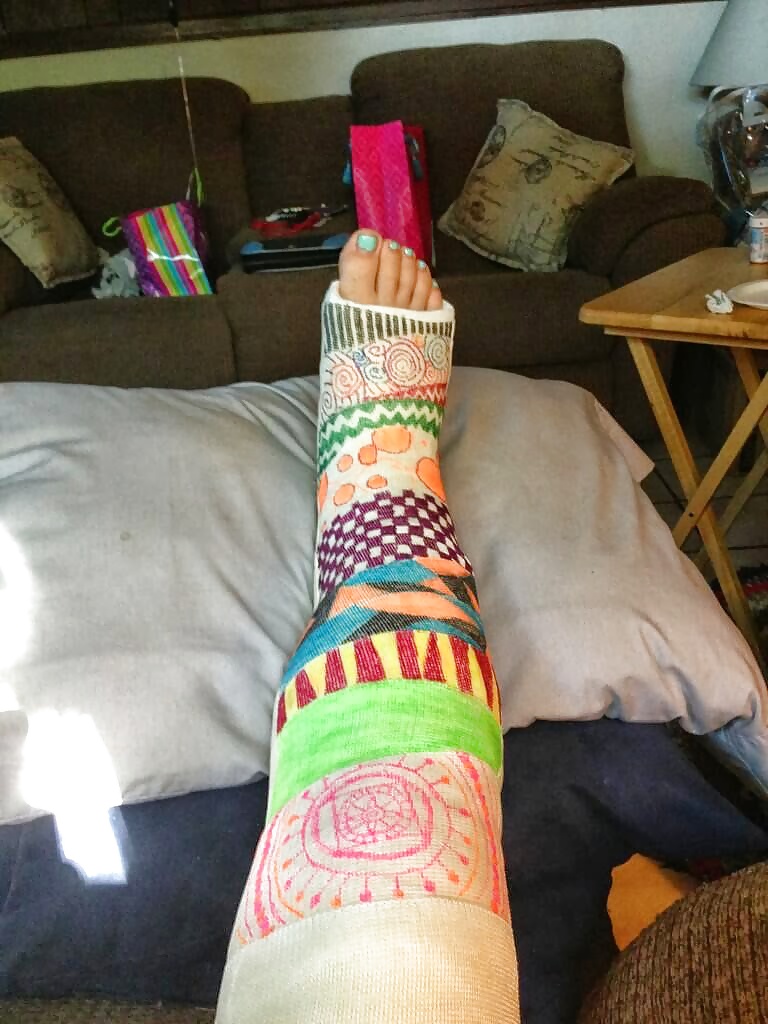 Leg cast fetish #32594082