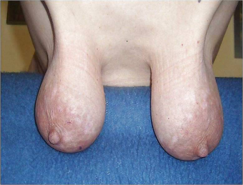 Stretch Marks, Scars and Saggy 27 #38015724
