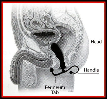 Aneros - massage de la prostate - masaje de la próstata
 #31682433