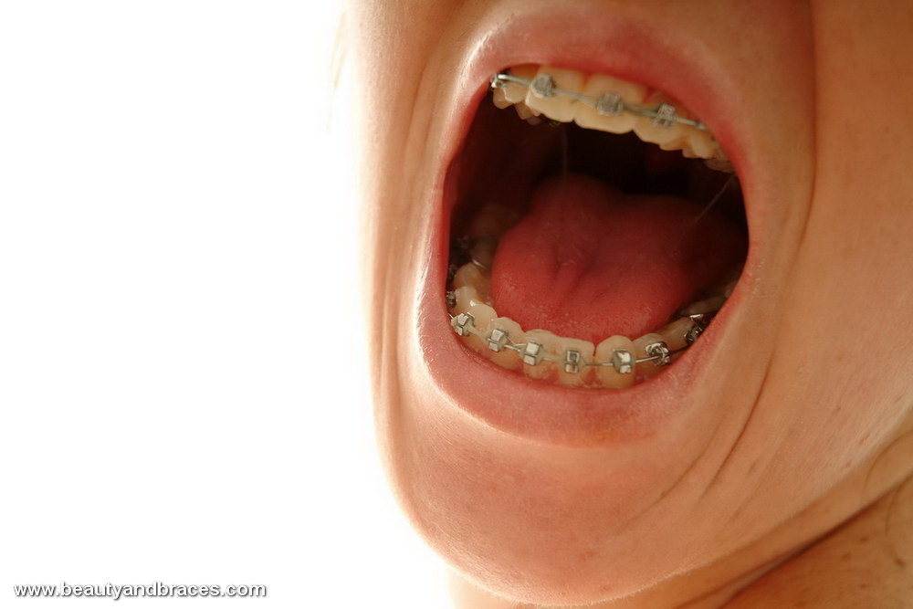 Une jolie petite fille ouvre sa bouche affamée de bite pour montrer son appareil dentaire sexy.
 #74631206