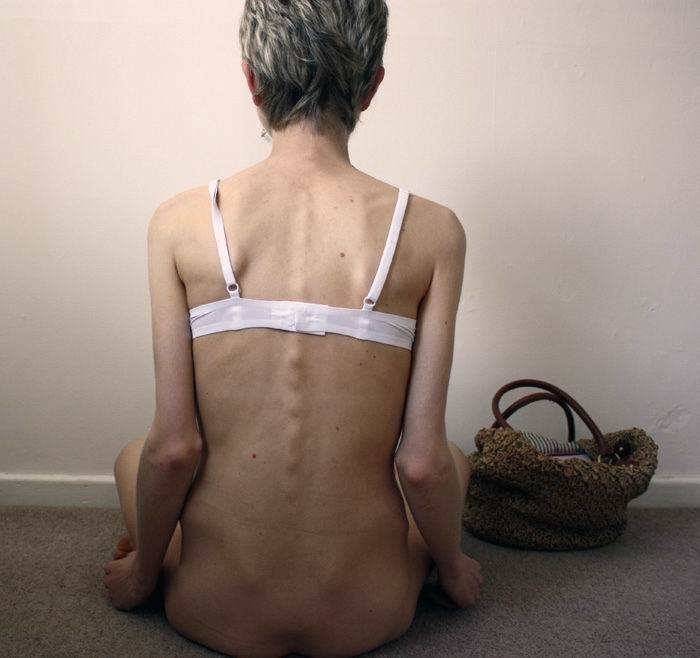 Ragazze anoressiche magre che mostrano le loro ossa
 #76487502