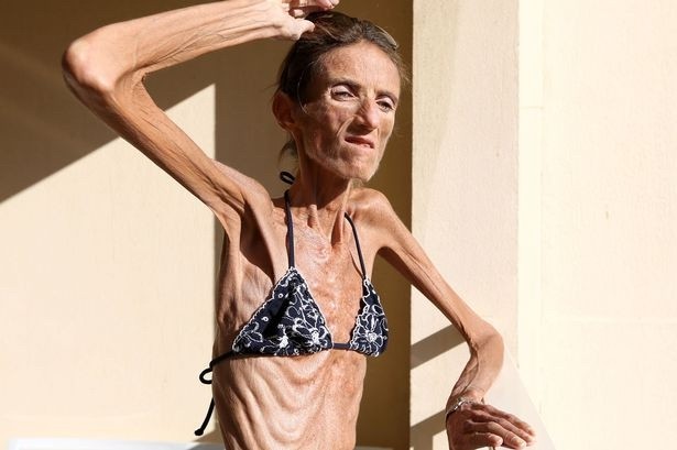 skinny anorexic girls posing and fucking #76488934