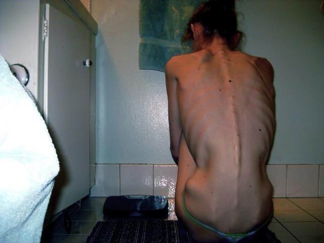 skinny anorexic girls posing nude for money #78732699